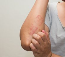 Allergies – Hypersensitivity Type 1