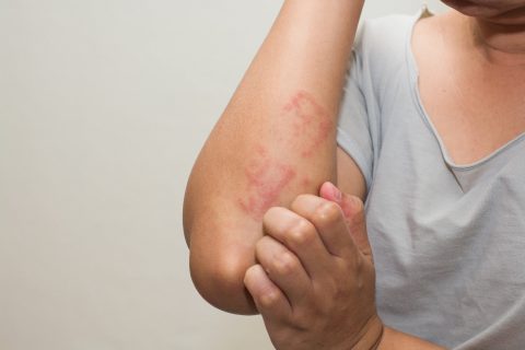 Allergies – Hypersensitivity Type 1